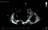 Non-Compaction Cardiomyopathy