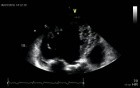 Non-Compaction Cardiomyopathy