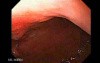 Adenocarcinoma of the Lesser Curvature with Signet Ring Cells (1 of 8)