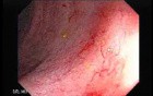 Prolapsed Hemorrhoid (3 of 4)