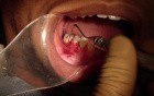 Part 8/8: Root Coverage Surgery - Mandibular Premolar - Completed Overview