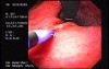 Hourglass Stomach - Constriction at the Proximal Gastric Corpus - Mallory-Weiss Syndrome