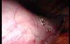Gastrointestinal Stromal Tumor - GIST (52 of 65)