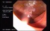 Adenocarcinoma Of The Transverse Colon - Endoscopy (2 of 9)