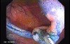 Sessile Tubulovillous Adenoma (8 of 11)
