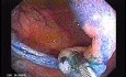 Sessile Tubulovillous Adenoma (8 of 11)
