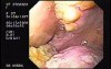 Oropharynge-Esophagic Candidiasis (3 of 5)