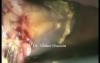 Cholecystectomy - Laparoscopic Approach