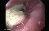 Esophageal Squamous Cell Carcinoma (1 of 5)