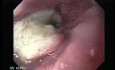 Esophageal Squamous Cell Carcinoma (1 of 5)