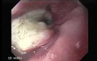 Esophageal Squamous Cell Carcinoma (1 of 5)