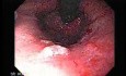 Endoscopic Baloon Dilation Of The Esophageal Stricture - Retroflexed Meneuver