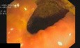Status Post Righ Hemicolectomy In Endoscopy