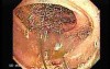 Dental Prothesis Found in the Jejuno (3 of 9)