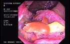 Rectal Adenocarcinoma - 53 Year - Old Man (1 of 2)