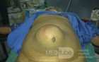 Large Umblical Hernia