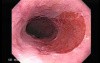 Gastric Heterotopia (inlet pach) (1 of 4)