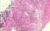 Small cell carcinoma of the lung that invades the upper and
 the middle third of the Esophagus (7 of 7)