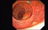 Tubulo-Villous Adenoma