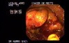 Rectal Adenocarcinoma - 73 Year - Old Man