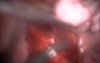 Laparoscopic Myomectomy