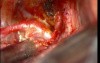 Brain Aneurysm - Anterior Communicating Artery - Microsurgery