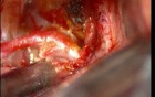Brain Aneurysm - Anterior Communicating Artery - Microsurgery