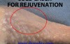 Laser skin rejuvenation  