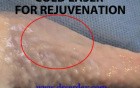 Laser skin rejuvenation  