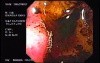 Zollinger- Ellison Syndrome - Gastric Ulcer with Gastrocolic Fistula (5 of 21)