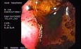 Zollinger- Ellison Syndrome - Gastric Ulcer with Gastrocolic Fistula (5 of 21)