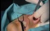 Rhinoplasty - T-excision for Tip Rotarion