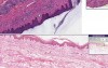 Lymphocytic infiltrate - Histopathology - Skin