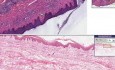 Lymphocytic infiltrate - Histopathology - Skin