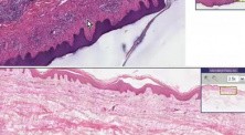 Lymphocytic infiltrate - Histopathology - Skin