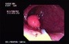 Endoscopic Polypectomy (1 of 2)