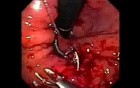 Retrograde Gastroplicature - Suturing - 2/3