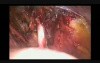 Laparoscopic pelvic lymphadenectomy