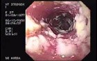 Oropharynge-Esophagic Candidiasis (5 of 5)