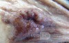 Early Gastric Cancer (10 of 21)