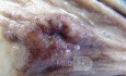 Early Gastric Cancer (10 of 21)