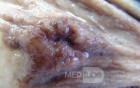 Early Gastric Cancer (10 of 21)