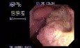Adenocarcinoma Of The Ascending Colon