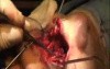 The Superior Rhinotomy