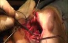 The Superior Rhinotomy