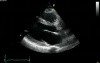 Parasternal View Long Axis - Normal Study