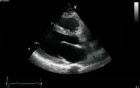 Parasternal View Long Axis - Normal Study