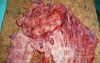 Adenocarcinoma of the cardias and gastric fundus with signet-ring cells (11 of 25)