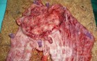 Adenocarcinoma of the cardias and gastric fundus with signet-ring cells (11 of 25)