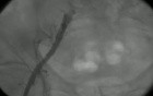 Stent In Femoral Artery